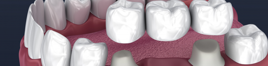 what-is-the-difference-between-dental-crowns-and-bridges