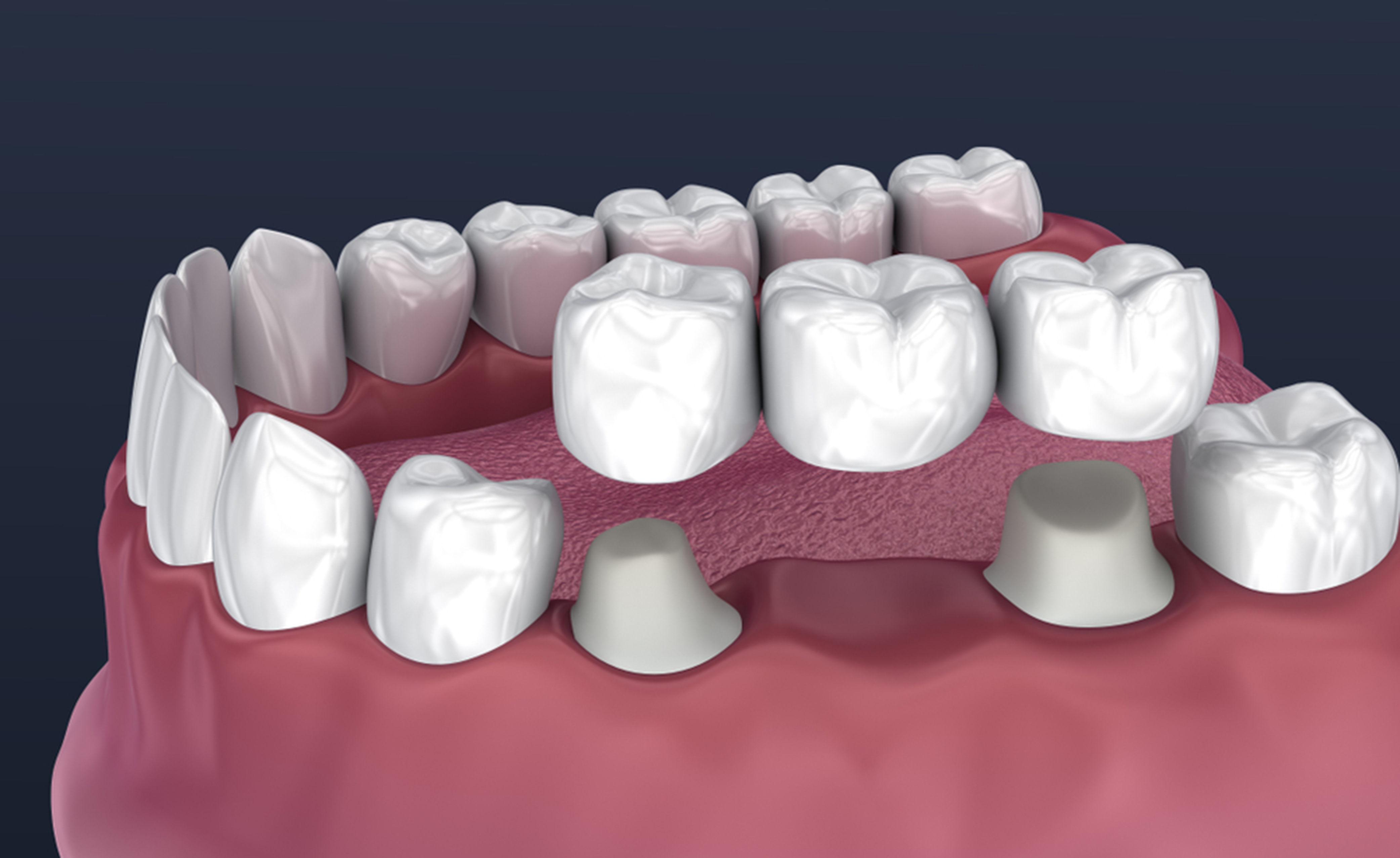 what is the difference between dental crowns and bridges