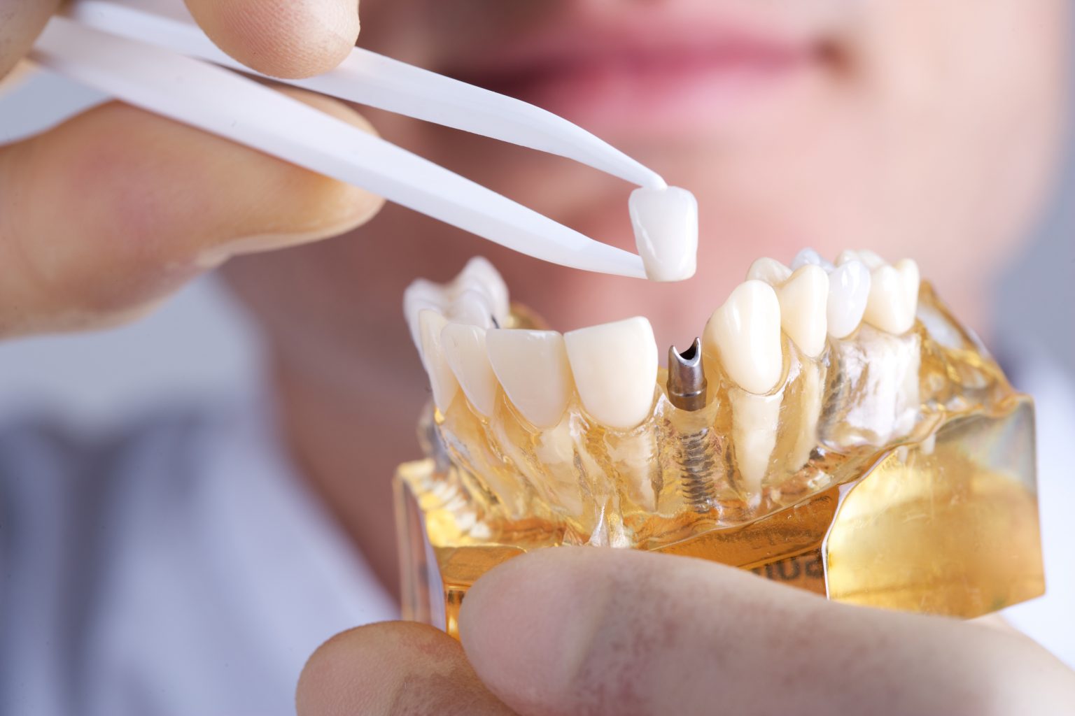are dental implants right for you