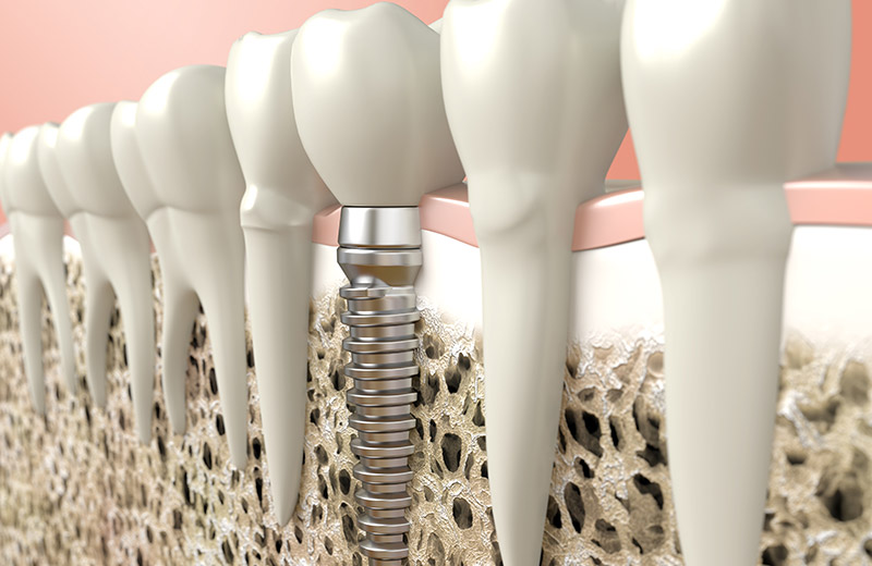 dental implants in ne calgary