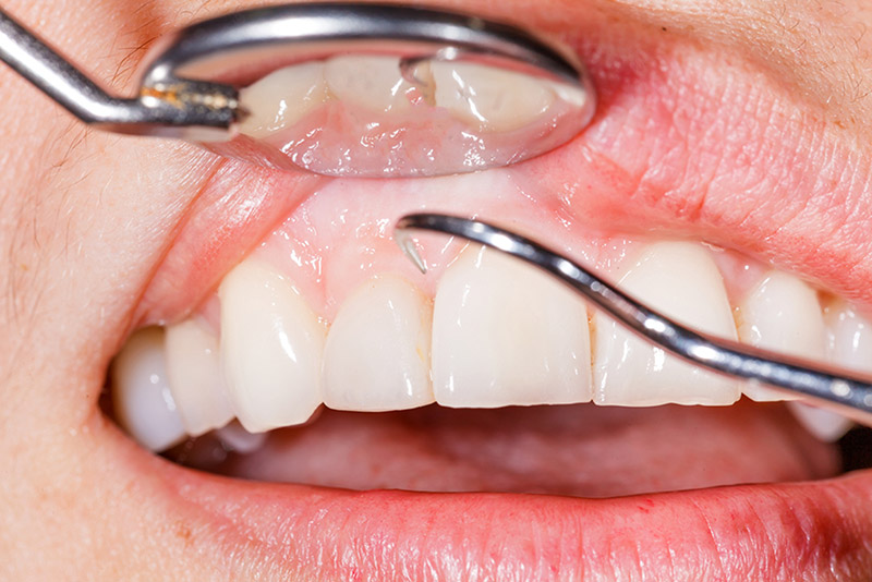periodontal treatment in ne calgary