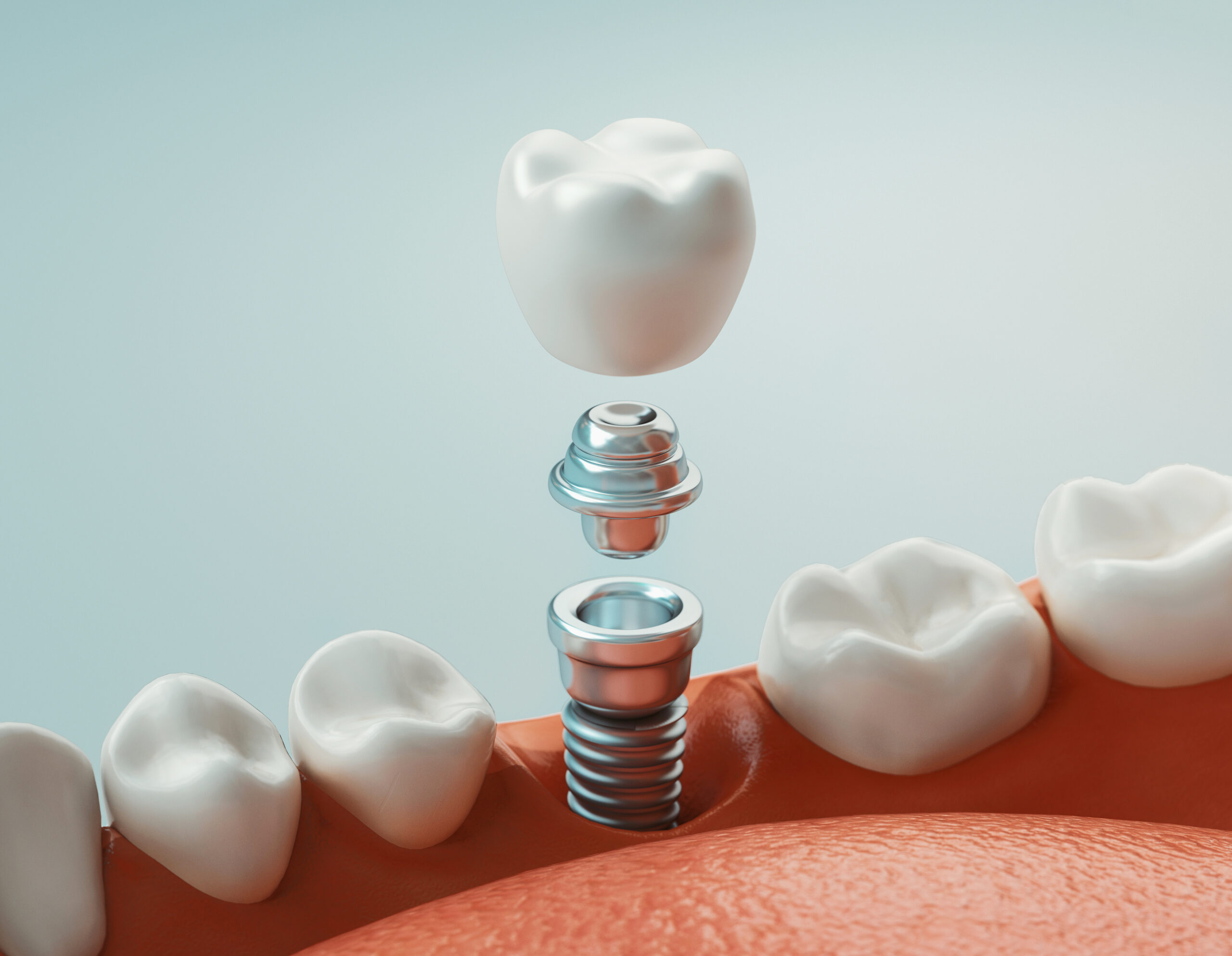 everything to know about dental implants