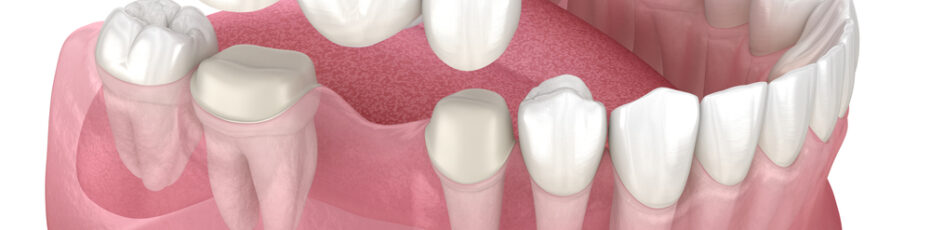 a guide to dental bridges types benefits and more