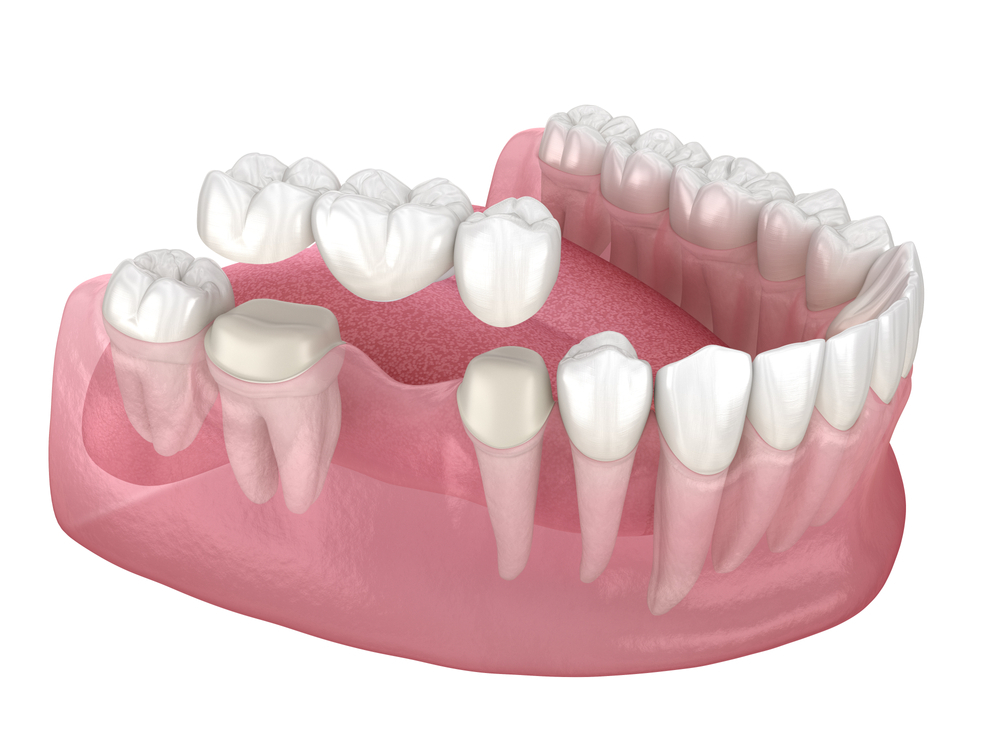 a guide to dental bridges types benefits and more