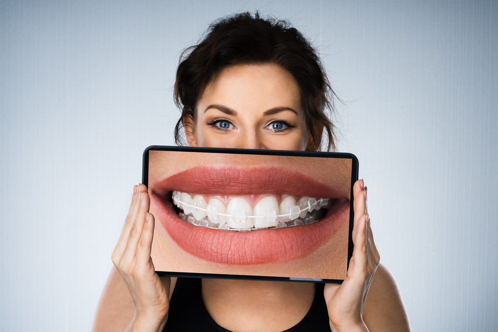benefits of ceramic braces for teens