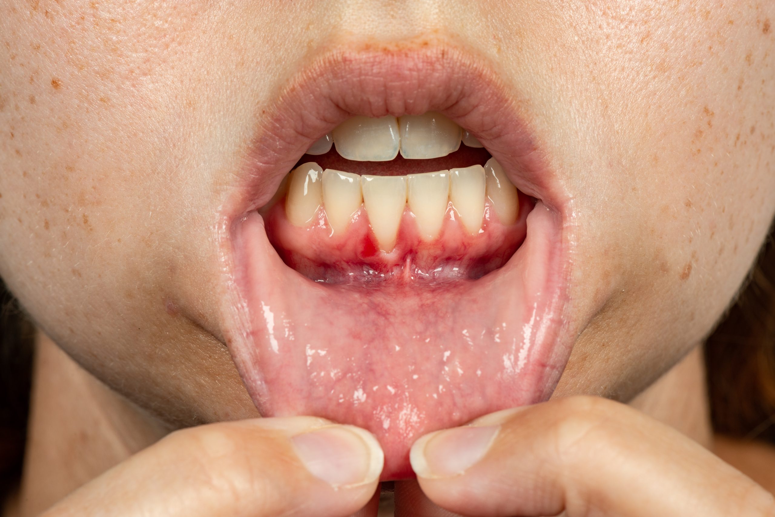 periodontal treatment in NE Calgary