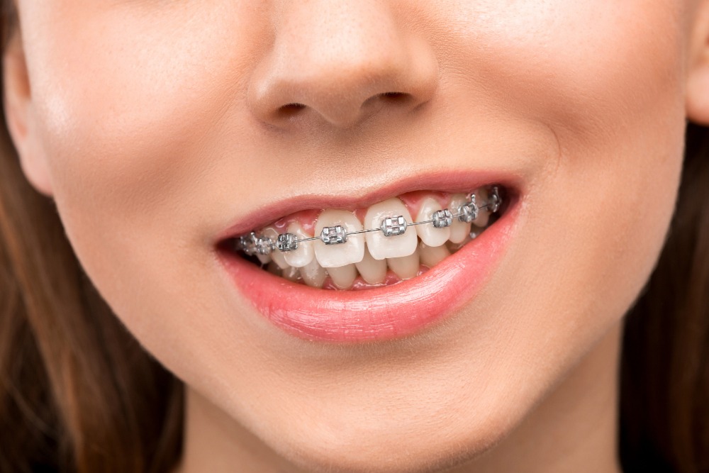 How Long Do You Need to Wear Braces?