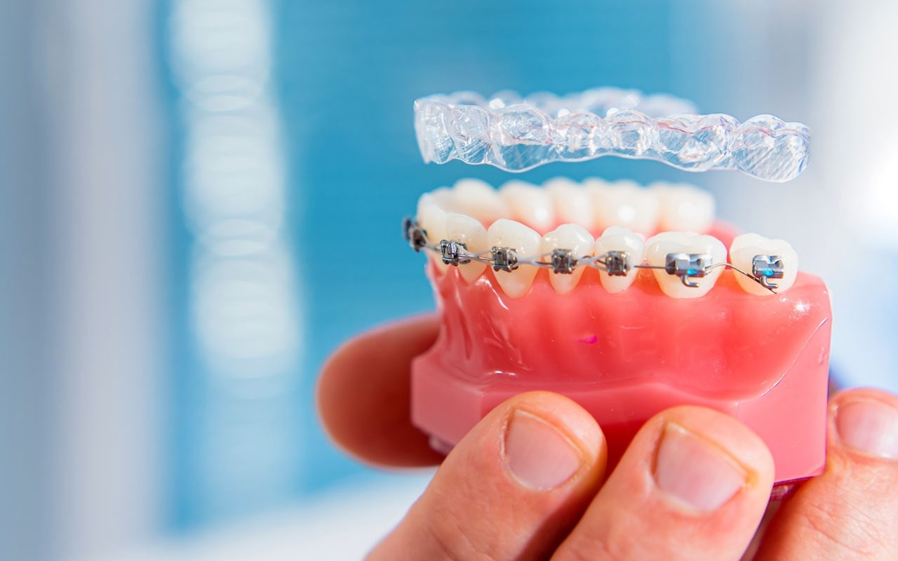 Invisalign in NE Calgary