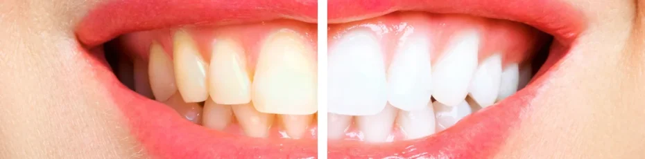 how can i fix yellow or stained teeth permanently
