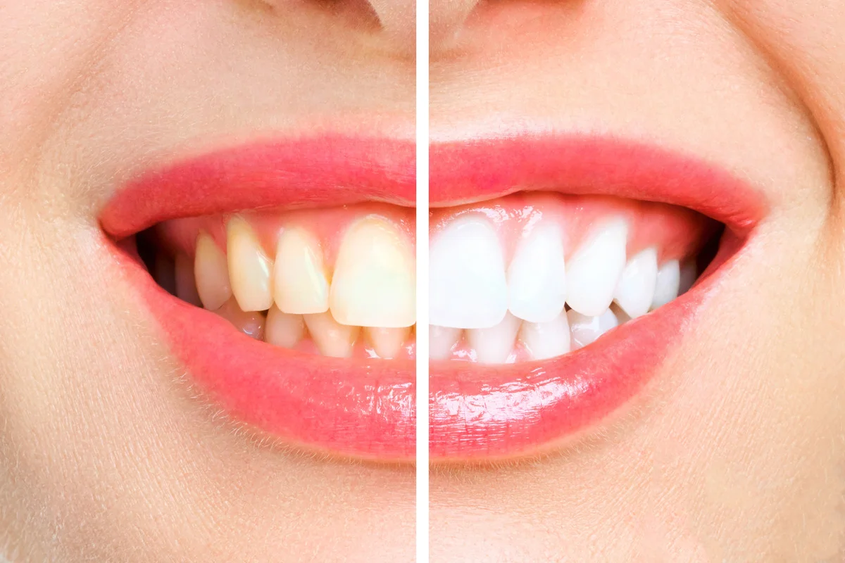 how can i fix yellow or stained teeth permanently