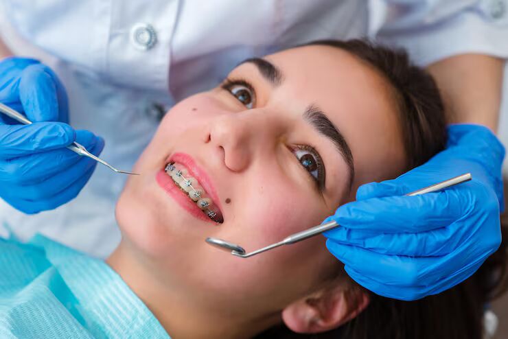 Dental Braces
